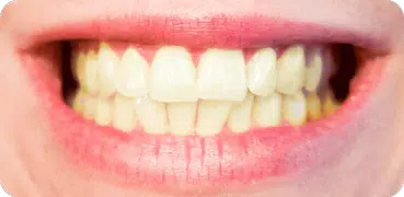 How to Whiten Teeth Instantly