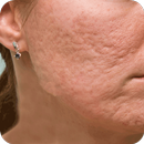 Acne Scar Removal Home Remedy APK