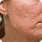 Acne Scar Removal Home Remedy アイコン