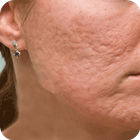 Acne Scar Removal Home Remedy-icoon