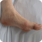 How to Get Rid of Gout simgesi