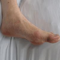 How to Get Rid of Gout اسکرین شاٹ 1