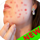 Acne tips and Remedies at Home : FREE APK