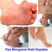 Tips to Overcome Foot Calluses icon
