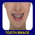 Tooth Brace Ideas
