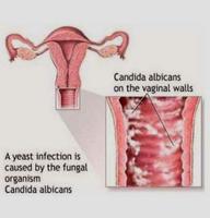 Vaginal Iinfection Guide постер