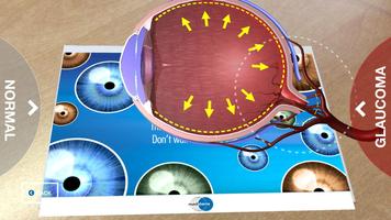 Glaucoma Education capture d'écran 3