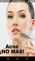 Acne No Mas 海報