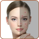Acne Remover - Pimple Remover APK