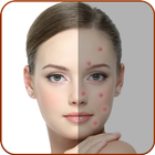 Acne Remover - Pimple Remover أيقونة