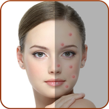 Acne Remover - Pimple Remover icône