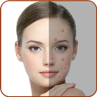 Acne Remover - Pimple Remover icon