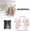 Mesothelioma Attorney Houston