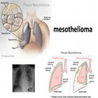 Mesothelioma Attorney Houston-icoon