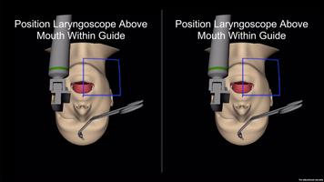 Laryngoscopy AR capture d'écran 1