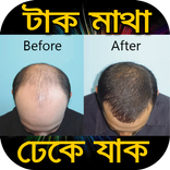 টাক মাথা ঢেকে যাক- মাথায় চুল গজানোর নতুন পদ্ধতি
