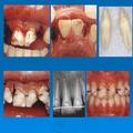 Trauma Dentoalveolar