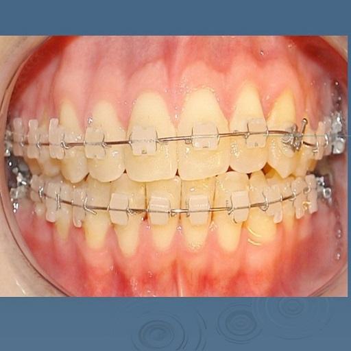 Type of brackets Type of brackets
