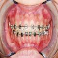 Do I need braces?