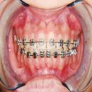 Do I need braces? APK