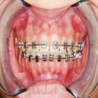 Icona Do I need braces?