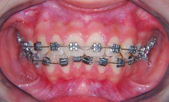 Necesito Brackets??? Poster