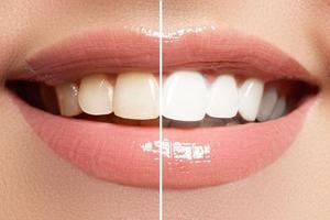 teeth whitening 2018 تصوير الشاشة 1