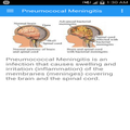 Pneumococcal Meningitis