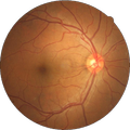 Diabetic Retinopathy Classification