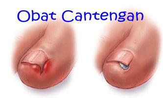 Obat Cantengan Alami screenshot 1