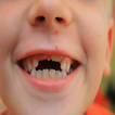 Repairing The Front Tooth