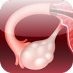 Polycystic Ovary Syndrome PCOS