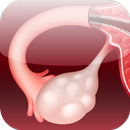 Polycystic Ovary Syndrome PCOS APK