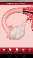 Polycystic Ovary Syndrome PCOS الملصق