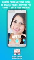 Before and After braces Photo اسکرین شاٹ 1