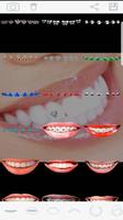 تجميل وتبييض الأسنان تقويم وترميم الفم Braces постер