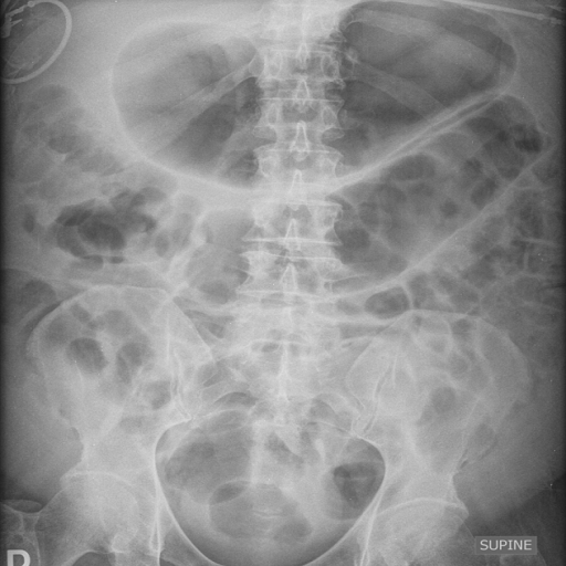 RADIOLOGY ACUTE ABDOMEN
