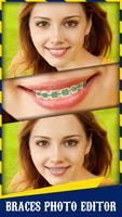 Braces স্ক্রিনশট 2