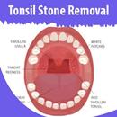 Tonsil Stone Removal APK