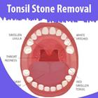 Tonsil Stone Removal icône