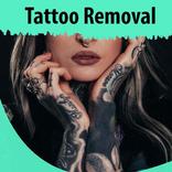Tattoo Removal