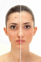 Acne Remover Photo Editor-poster