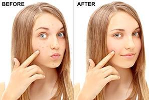 Acne Remover Photo Editor 스크린샷 1