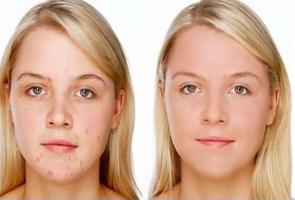 Pimple Remover bài đăng