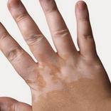 علاج البهاق