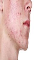 O tratamento da acne imagem de tela 1
