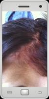 Scalp Psoriasis poster