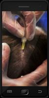 Scalp Psoriasis screenshot 1