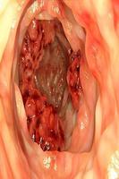Le cancer du colon & du rectum Affiche