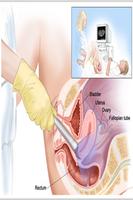 cancro do ovário imagem de tela 1